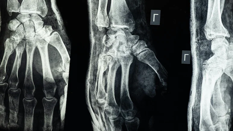 Científicos chinos crean un "pegamento para huesos" que repara fracturas en solo 3 minutos.